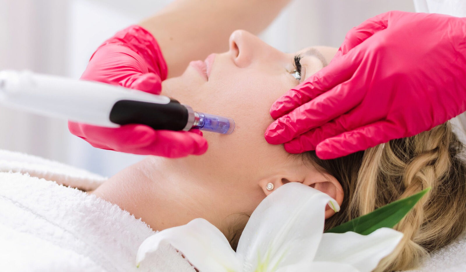 A women receiving a microneedling treatment by a dermatologist.