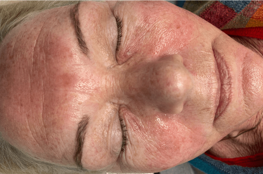 Before of IPL treatment